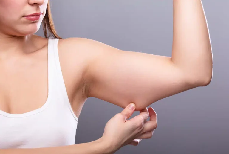 lipoedem-arme-2